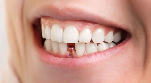 implant dentar la oferta